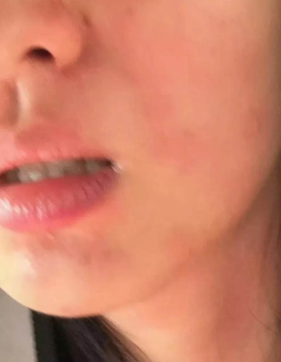 女演员王楚然求治荨麻疹，网友大呼感同身受：太折磨人
