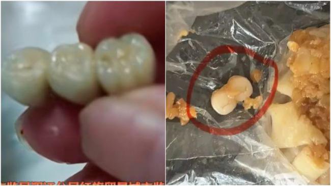 吓人！吉林香肠吃出3颗牙 广东烧麦吃出2颗