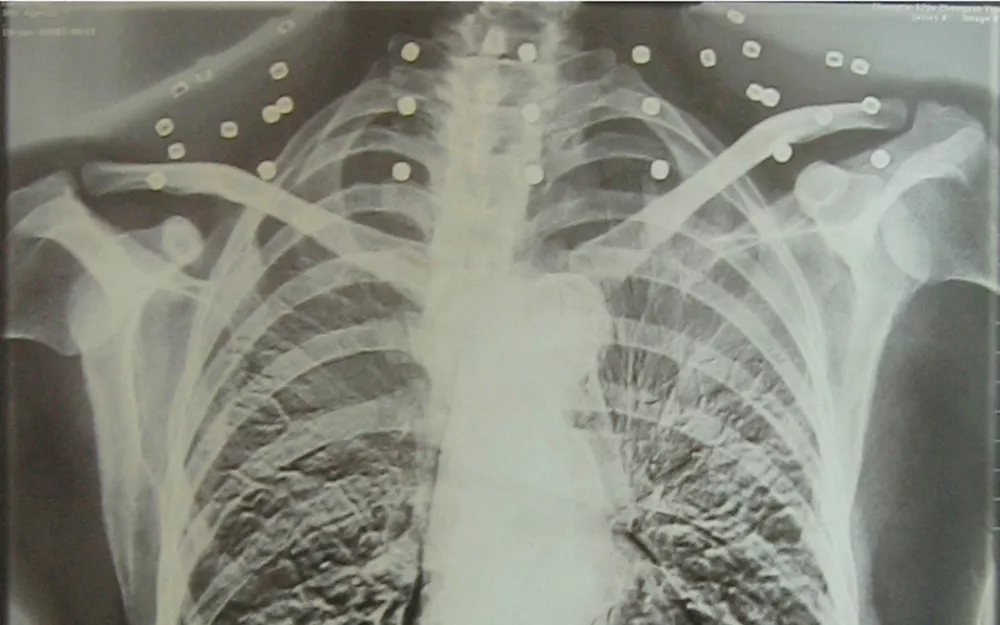 "老先生，您把项链取下来再做CT""你看是不是弹片"