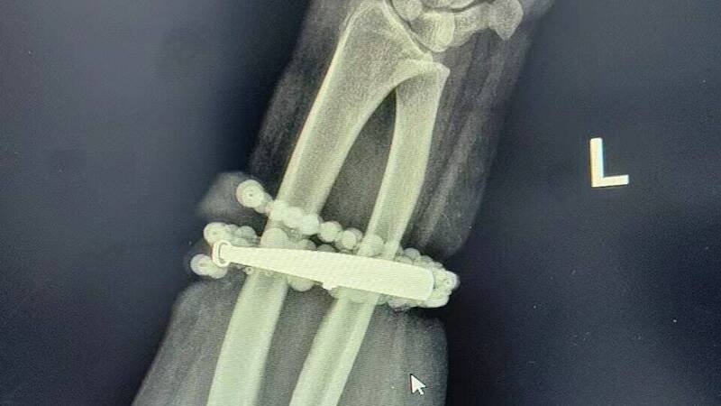 中国福建一名33岁龚姓女子戴银手环和串珠长达10年未摘下，竟长进肉里，差点要截肢。（图翻摄自微博）