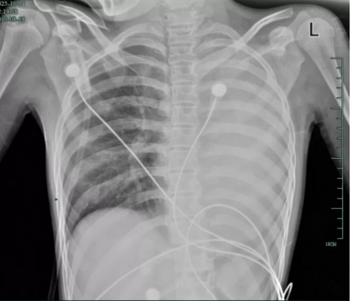 12岁女孩发热1天肺全白！这种会堵死气道的病，别当普通感冒