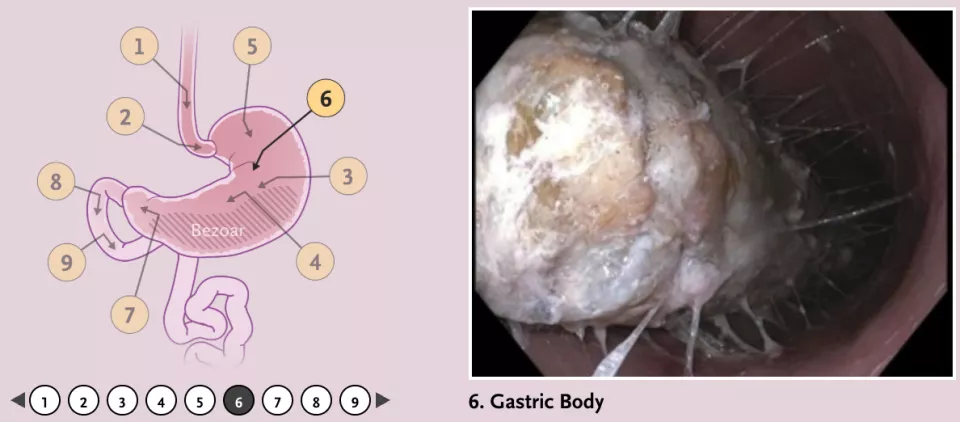 网红神药，让她减重36斤后胃里长出“石头”